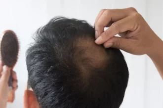 Hair Loss